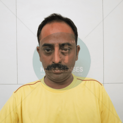 Hair Transplant Journey